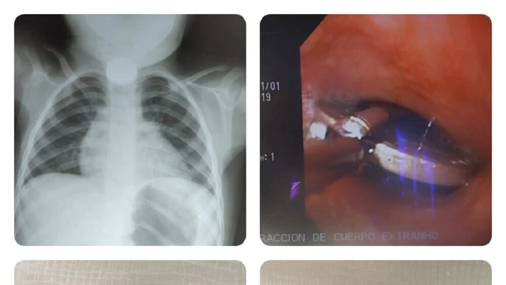 Médicos extraen con éxito una moneda tragada por un niño de 2 años en San Pedro