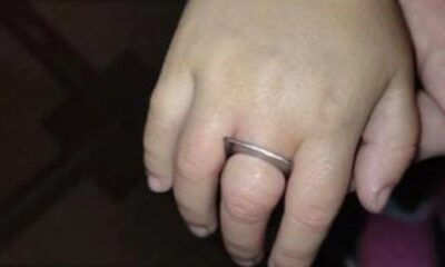 Regla de metal queda atascada en el dedo de una niña de 3 años