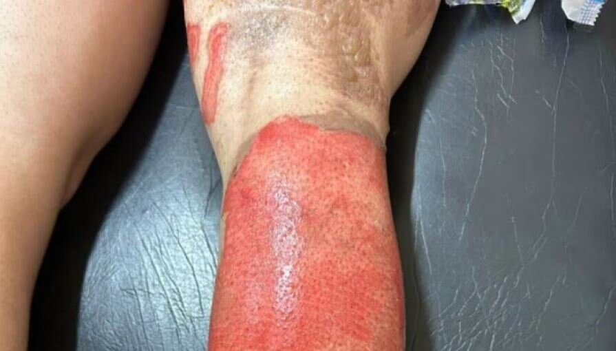 Mujer sufre graves lesiones tras ser rociada con alcohol y le prendieran fuego