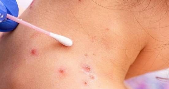Viruela del mono: Paraguay registró más de 120 casos entre 2022 y 2023