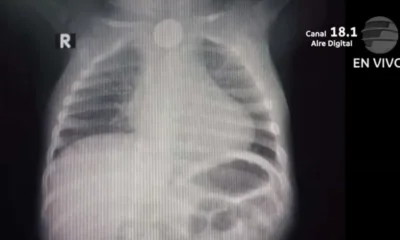 Niño de un año tragó una pila y debe someterse a un procedimiento de urgencia