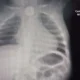 Niño de un año tragó una pila y debe someterse a un procedimiento de urgencia