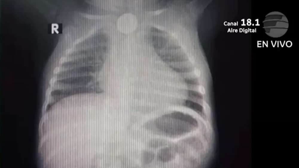 Niño de un año tragó una pila y debe someterse a un procedimiento de urgencia