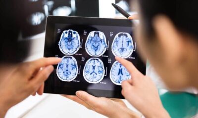 Tumor cerebral y sus signos de alerta: detección temprana marca diferencias