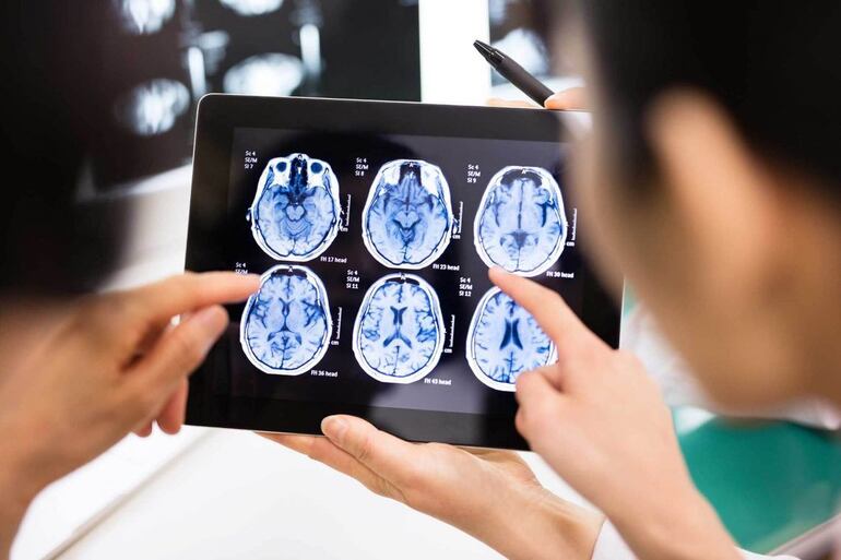Tumor cerebral y sus signos de alerta: detección temprana marca diferencias